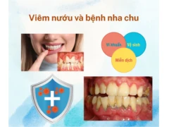 Viêm nướu và Bệnh Nha Chu